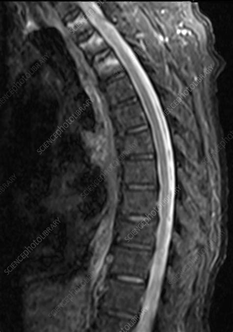 Bone marrow edema, MRI - Stock Image - C039/3660 - Science Photo Library