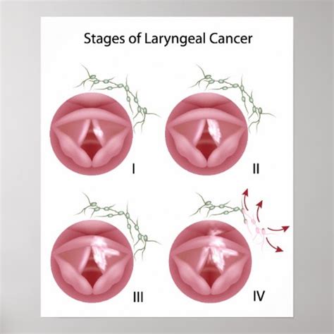 Laryngeal cancer stages Poster | Zazzle