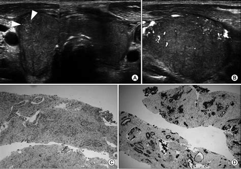 Type IA thyroid metastases in a 61-year-old male with lung cancer ...