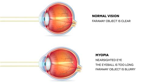 A Comprehensive Guide to Myopia (Short-Sightedness) | Laser Eye Surgery Hub