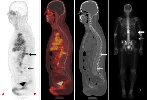 Pet Scans to Image Prostate Cancer Toward Mainstream Clinical Use ...