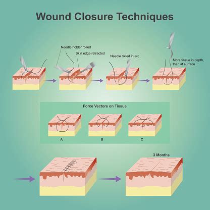 Wound Closure Techniques Stock Illustration - Download Image Now - iStock