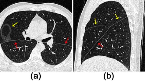 Lung Fissure Ct Scan