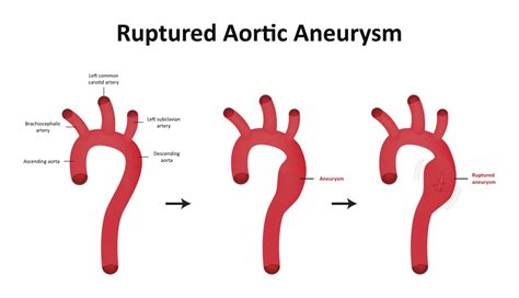 Thoracic Aortic Dilatation | ILLAWARRA Heart Centre