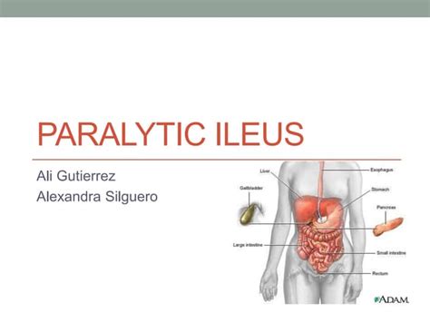 Paralytic ileus | PPT