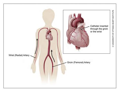 Angiogram (Cardiac Catheterization) - Ottawa Heart Institute