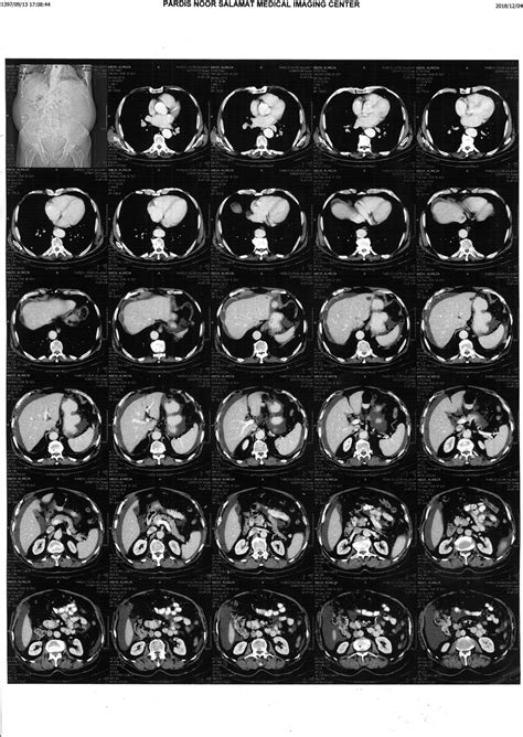 The first CT Scan of the patient on 30/11/2018 | Download Scientific ...