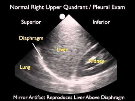 pleural effusion cat ultrasound - Dulcie Dunbar