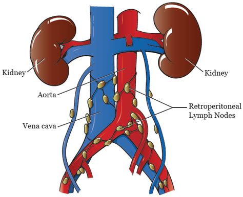 About Your Retroperitoneal Lymph Node Dissection | Memorial Sloan ...