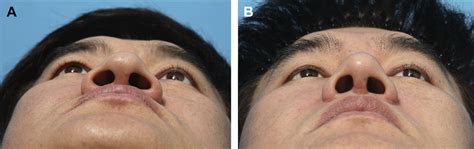 Alar Base Reduction and Alar-Columellar Relationship - Facial Plastic ...