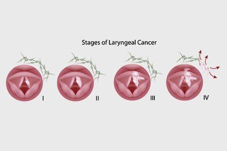 Stages Of Throat Cancer