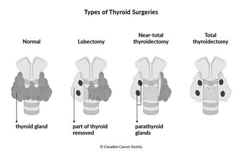 Surgery for thyroid cancer | Canadian Cancer Society