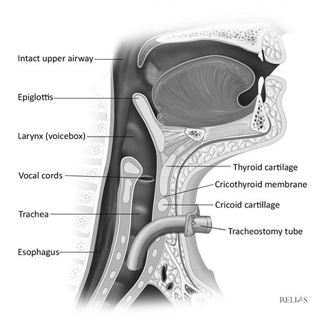 Tracheostomy Tube Insertion