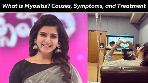 Autoimmune Disease Actress Samantha Ruth Prabhu suffers from myositis ...