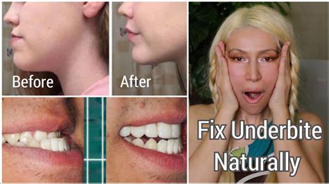 How To Fix An Underbite Naturally | Correcting Protruding Jaw and Chin ...