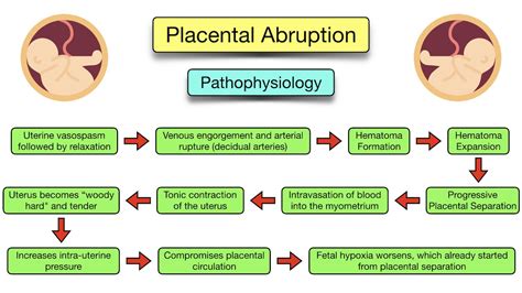 Placental Abruption: Symptoms, Causes, Treatment, Types, Ultrasound ...