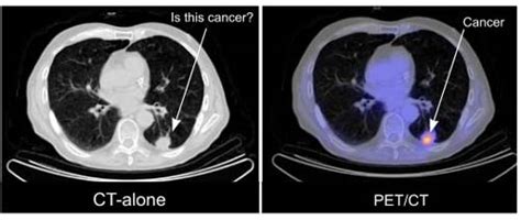 Pet Scan Images Lung Cancer