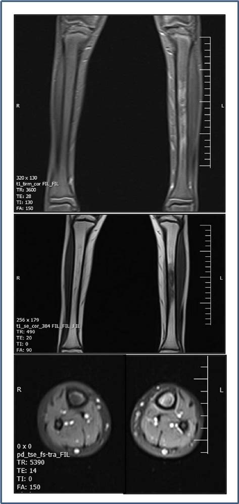 MRI PD image showed bone marrow edema with high signal intensity in the ...