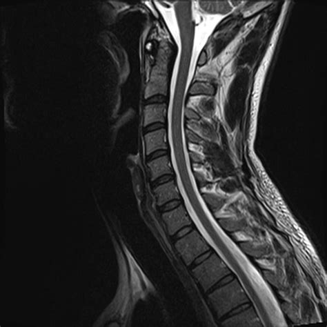 Related Keywords & Suggestions for normal cervical spine mri