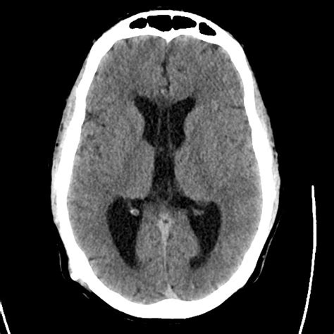 Differential Diagnosis of CSF Shunt Complications