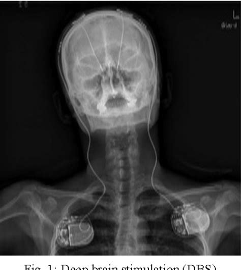 Figure 1 from Deep Brain Stimulation for Parkinson's Disease | Semantic ...