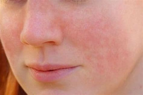 Types And Causes For Lupus Rash