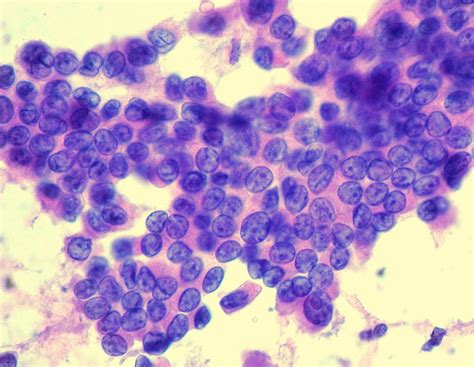 Carcinoma Papilífero da Tiróide: Sintomas, Causas, Diagnóstico ...