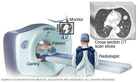 CT scan slices - Mayo Clinic