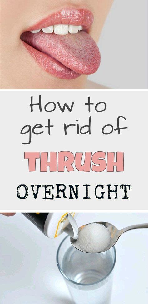 Learn how to get rid of thrush overnight. #BeautyMakeup # ...