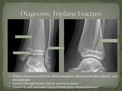 Triplane Fracture