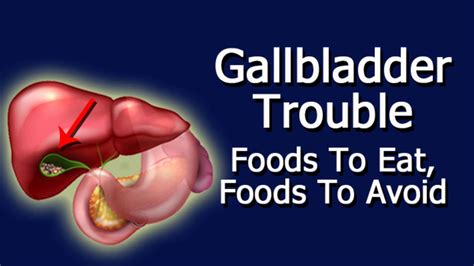 Gallbladder Trouble - Foods To Eat, Foods To Avoid - YouTube