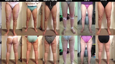 Lipedema lipoedema Awareness Days 27 & 28 Stages 1&2 lipedema before ...