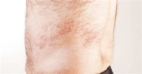 does shingles leave scars - Captions Swap