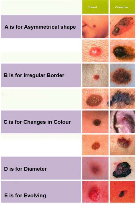 131 best images about Melanoma on Pinterest | Wear sunscreen, New skin ...