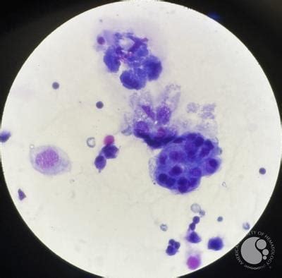 Lung cancer metastasis to pleural fluid