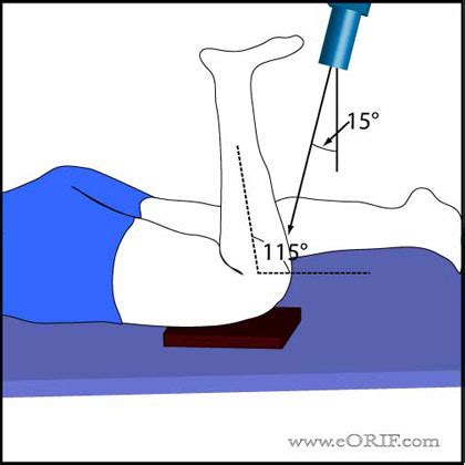 Sunrise Knee X Ray Positioning