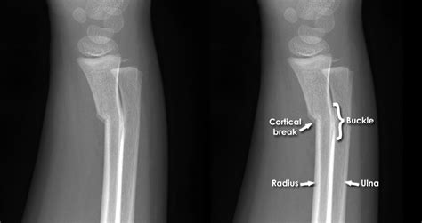 Greenstick Fracture X Ray