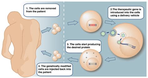 Gene Therapy Made Simple, Just for You - Patient Worthy