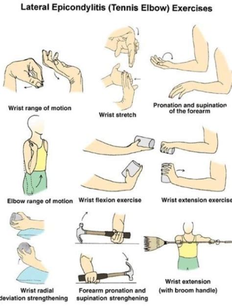 Lateral Tendonopathy / Tennis Elbow — Woollahra Physiotherapy