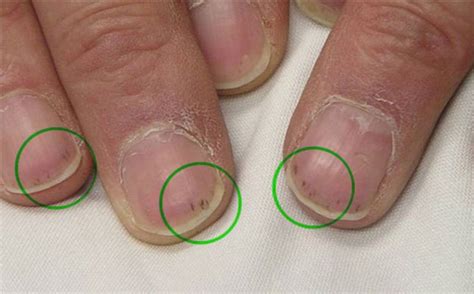 Splinter haemorrages | Clinical Diagnosis | Pinterest