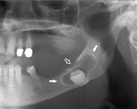 Eruption Cyst Radiography