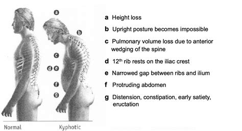 Cheltenham Spine Clinic - Osteoporotic Vertebral Compression Fractures