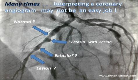 Coronary Angio Anatomy