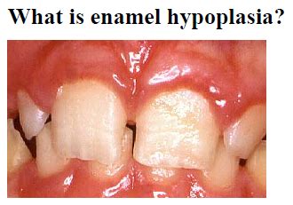 kRes8-Enamel Hypoplasia - dentist Appleton WI - Dental Haven - Dr ...