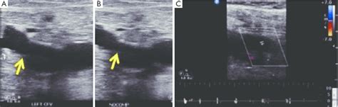 Acute deep vein thrombosis on ultrasound. Gray scale ultrasound ...