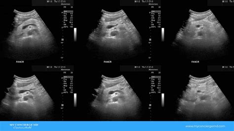 Echogenic Pancreas Ultrasound: All You Need To Know - MyConciergeMD