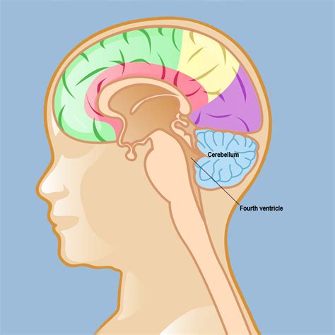 Medulloblastoma