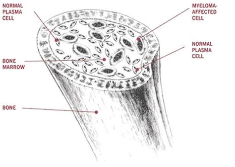 Bone Marrow Cancer Symptoms - Health Care Fix