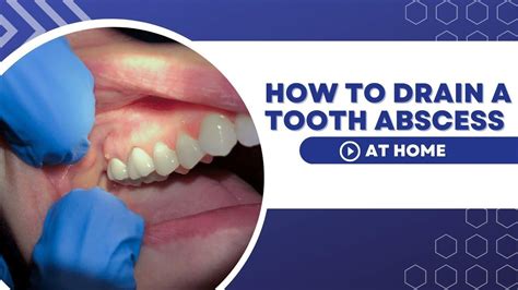 6 Best Ways to Drain a Tooth Abscess at Home - Early Finder