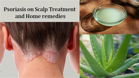 Psoriasis on Scalp Treatment and Home remedies